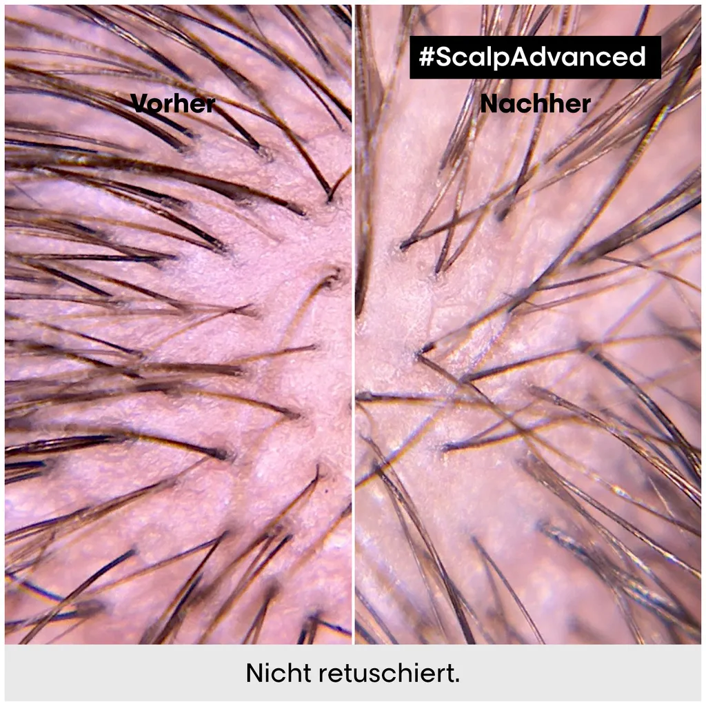 L'Oréal Scalp Advanced Anti-Discomfort Intense Soother Treatment