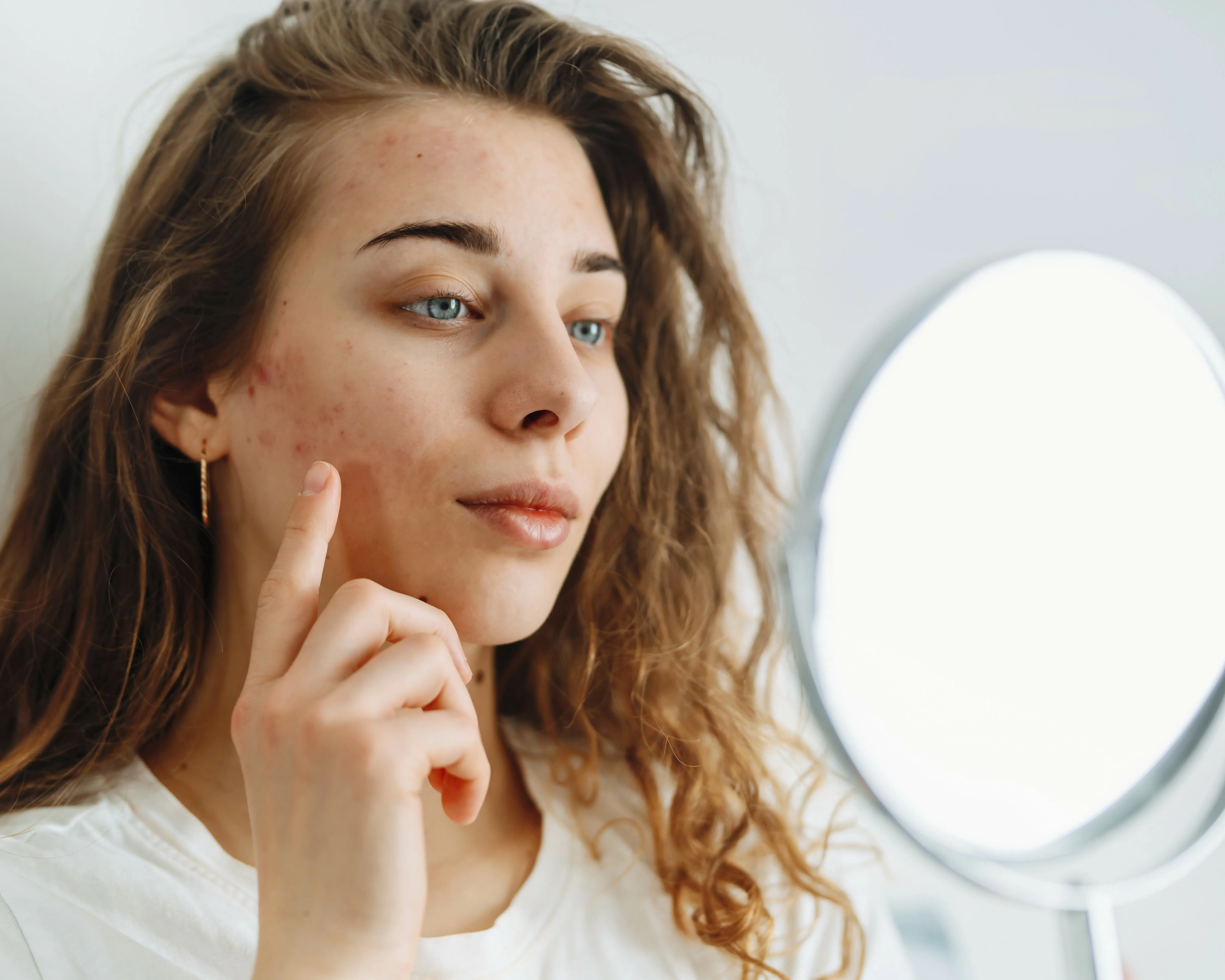 Frau mit unreiner Haut sieht in den Spiegel